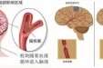 认识中风，预防中风，治疗卒中