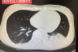 IOE助飞吞咽障碍患者的康复之路