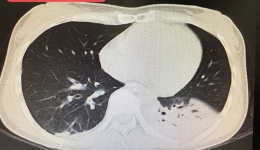 IOE助飞吞咽障碍患者的康复之路