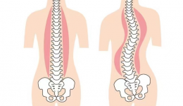 快来筛查矫正：别让孩子“长歪了”！
