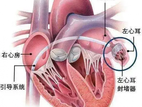 房颤治疗再上新台阶：我院开展首例经皮左心耳封堵术