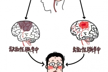 打破认识误区，脑卒中早期康复该这样做