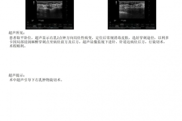 长结节别慌！精准手术让她不纠“结”