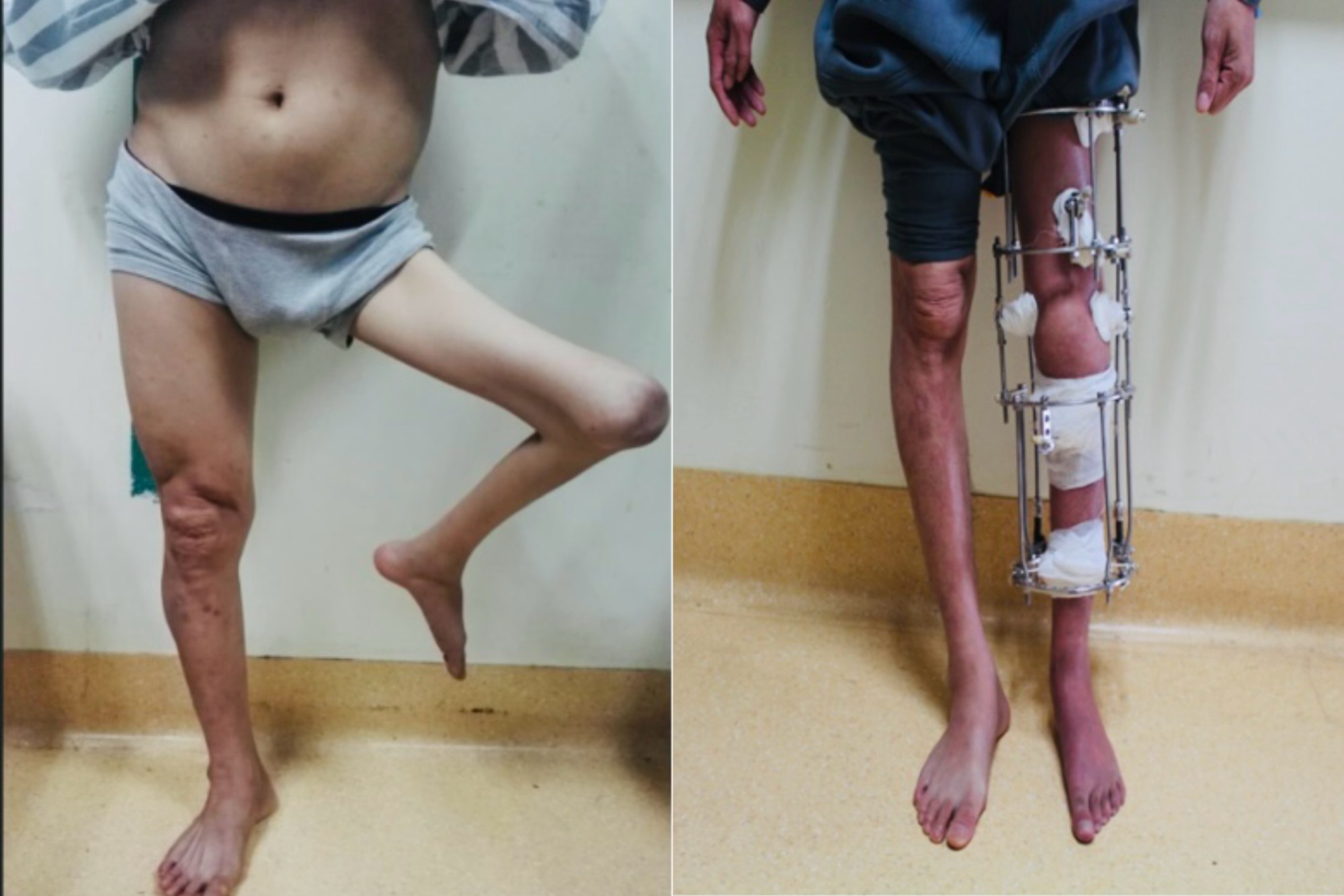 llizarov矫形技术