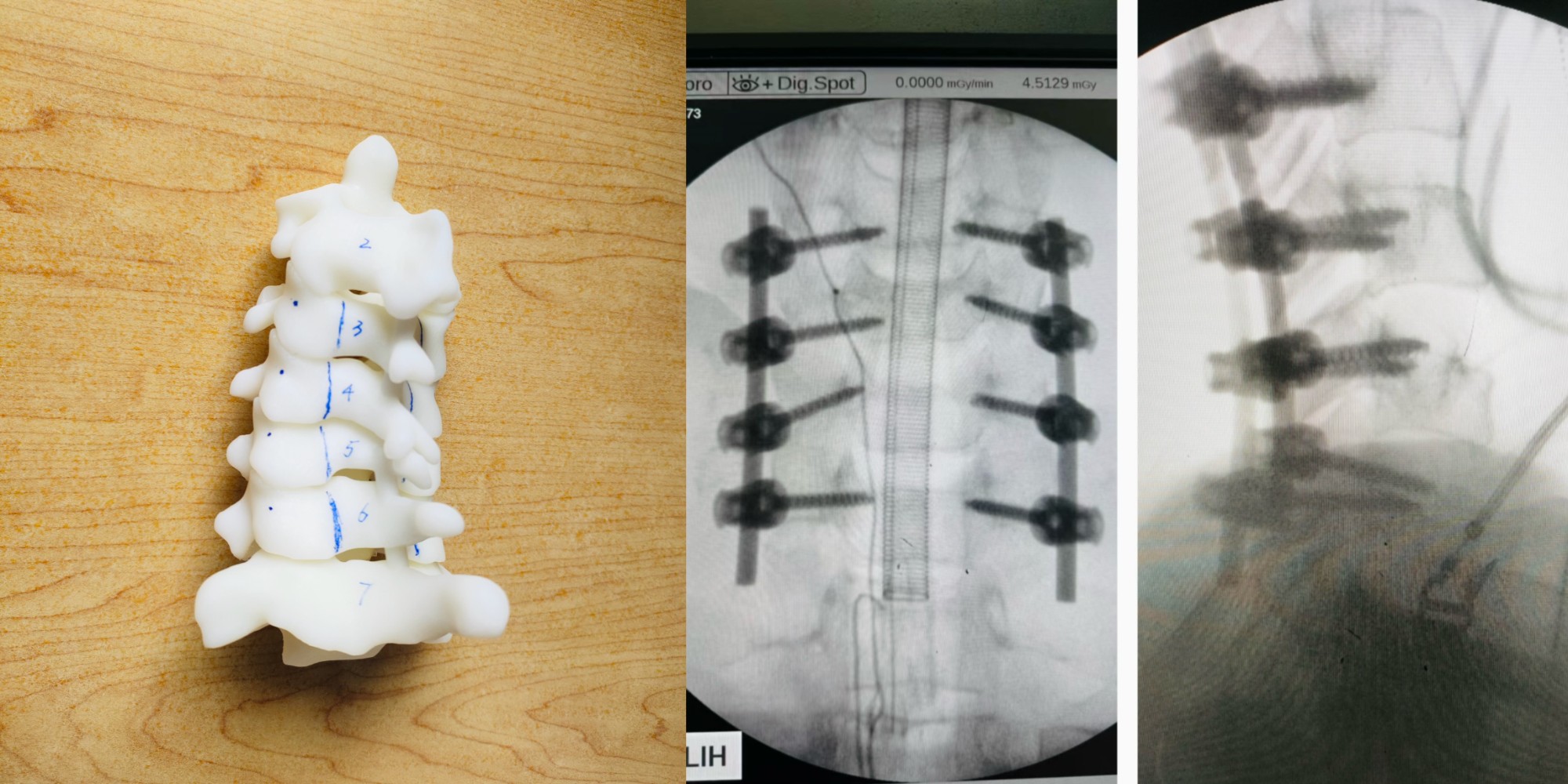 颈椎手术应用3D打印技术精准定位