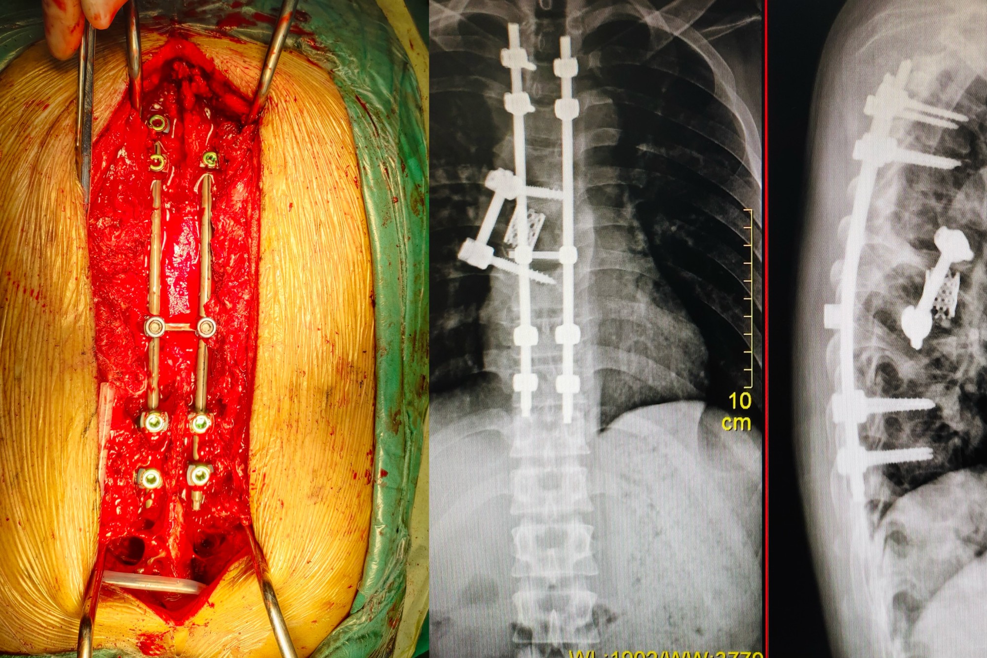 脊柱骨折减压椎弓根螺钉内固定术1
